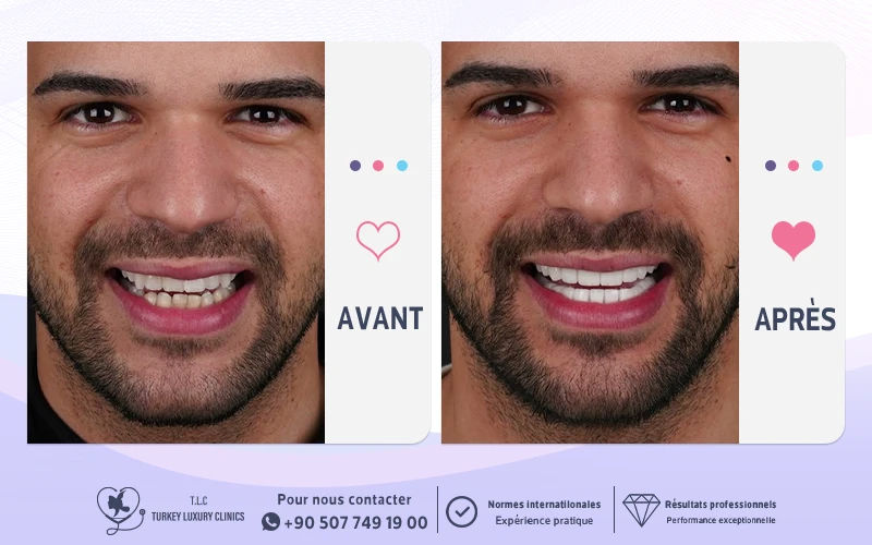 Photos avant et après du sourire d’un patient