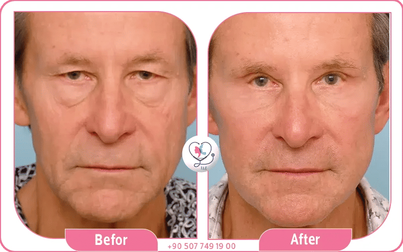 Best Hospitals for Facelift Surgery in Turkey