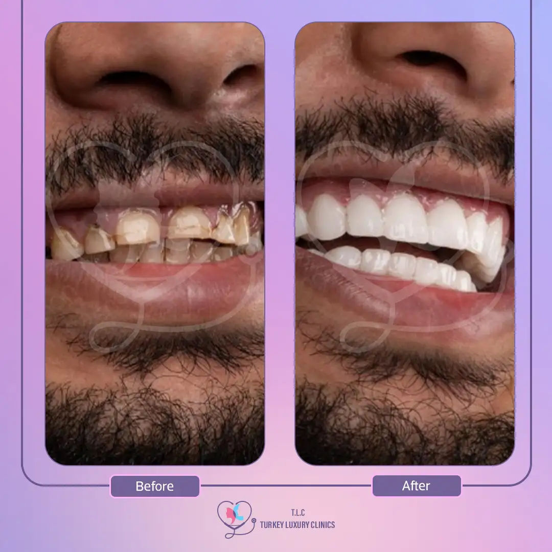 ثالثاً تجنب الأطعمة والمشروبات المسببة للتصبغات