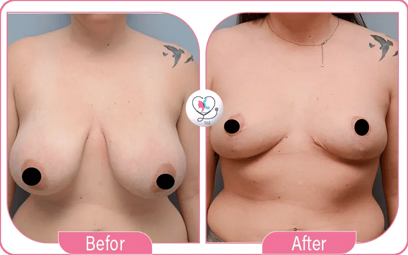 Résultats du réduction mammaire