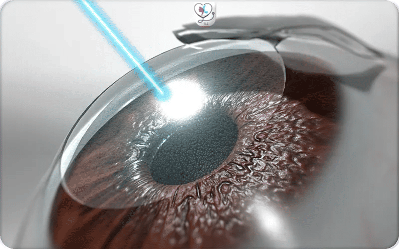 Qu’est-ce que l’opération LASIK des yeux ?