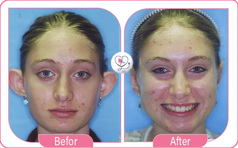 Otoplasty Before and After Photos 2