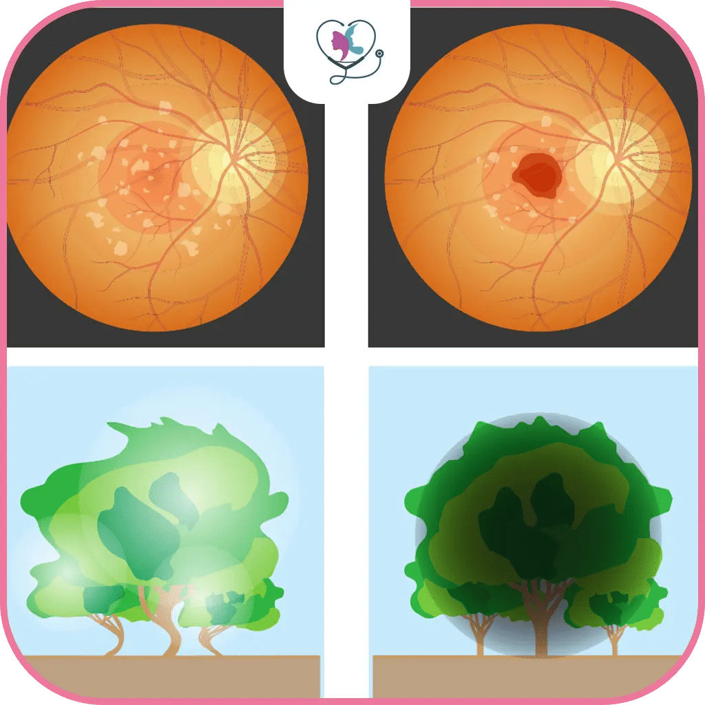 أعراض التنكس البقعي