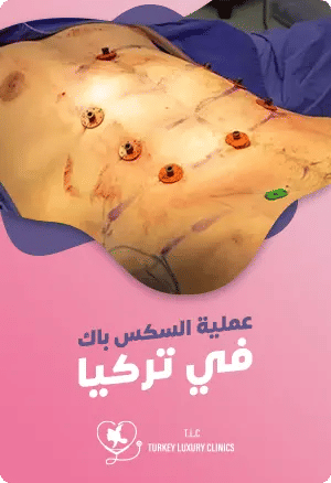 عملية Six-Pack في تركيا: دليلك الشاملfeatured image