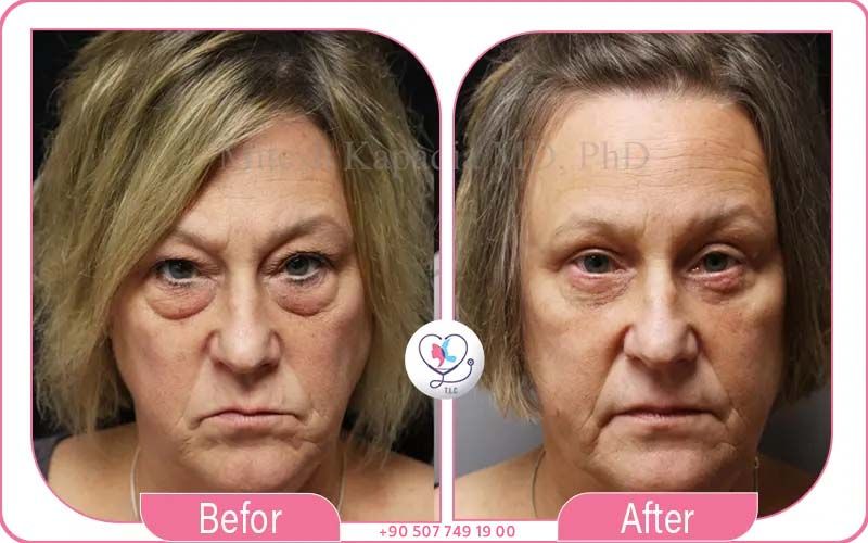 سعر عملية قص الجفون حسب الدول الأوربية