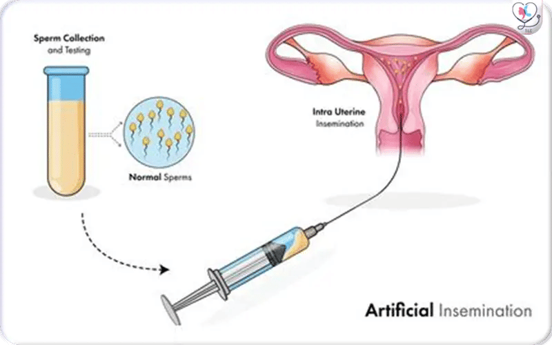 Les différents types d’insémination artificielle
