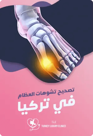 جراحة تصحيح تشوهات العظام في تركياfeatured image