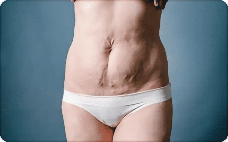 What are the Causes of a Lumpy Stomach After Liposuction?