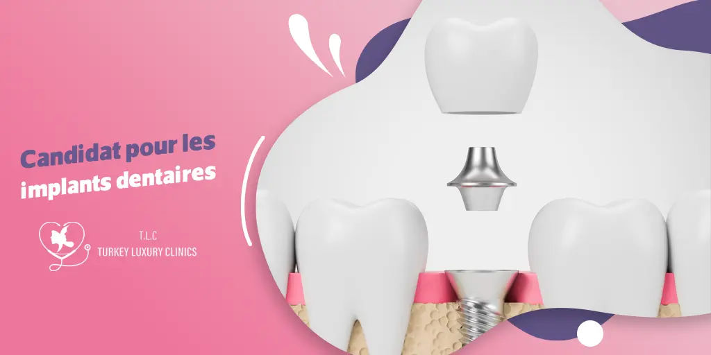 Candidat pour les implants dentaires