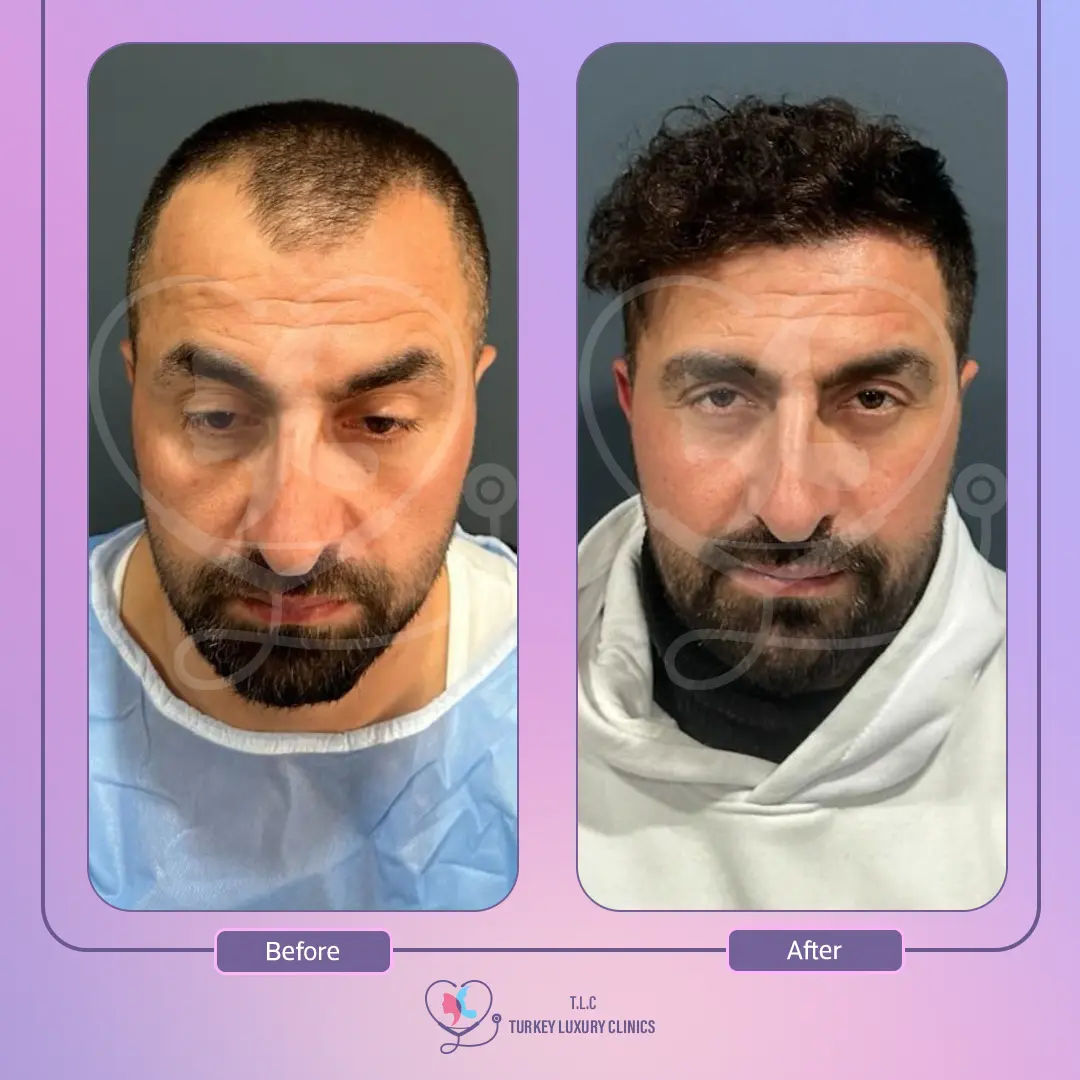 المرشحون المثاليون لزراعة الشعر مع تركيا لاكشري كلينك
