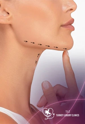 Chin Liposuction in Turkey 2026: Cost, Procedure & Results