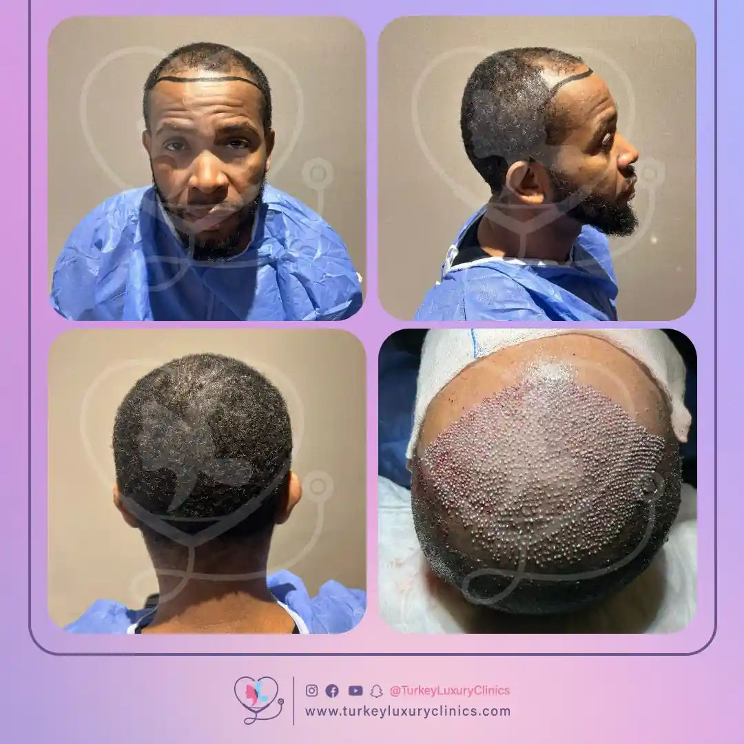 تجربتي مع زراعة الشعر بالصور