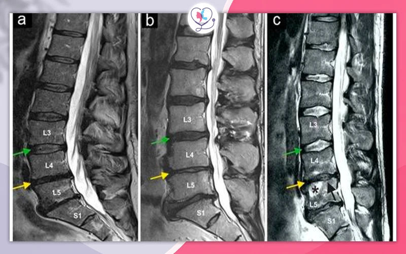 Stem Cell Therapy for L5-S1 Herniated Disc