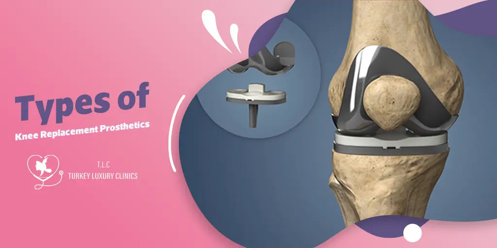 Types of Knee Replacement Prosthetics