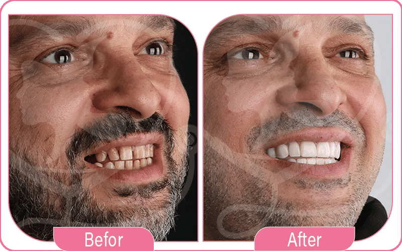 Hollywood Smile Designs Before & After Photos
