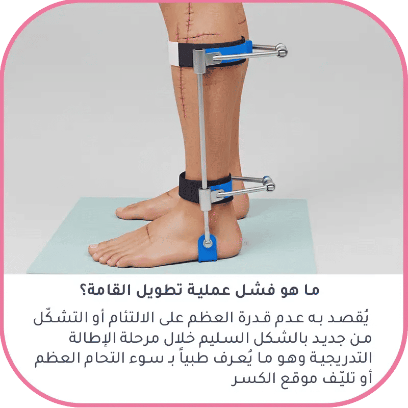 ما هو فشل عملية تطويل القامة؟