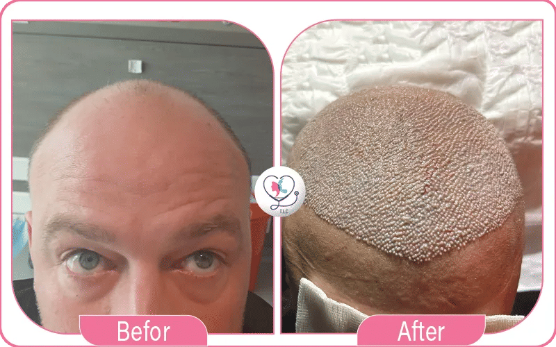 Get Affordable, Reliable Hair Restoration with Turkey Luxury Clinics