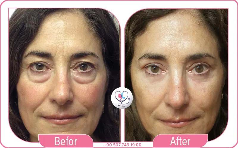 Best Hospitals & Clinics for Blepharoplasty in Turkey