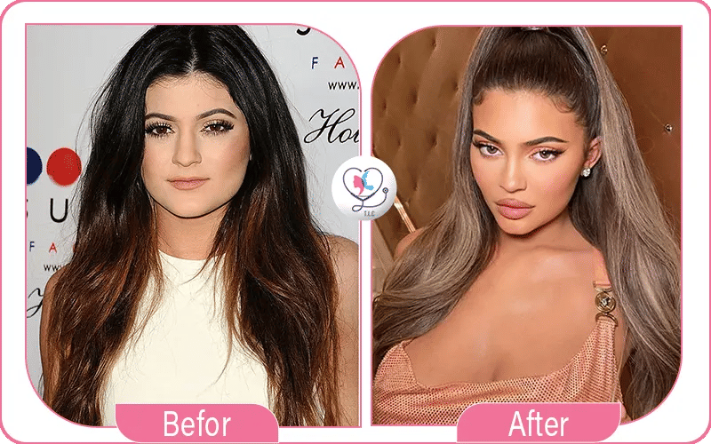 le nez de Kylie Jenner et les transformations faciales