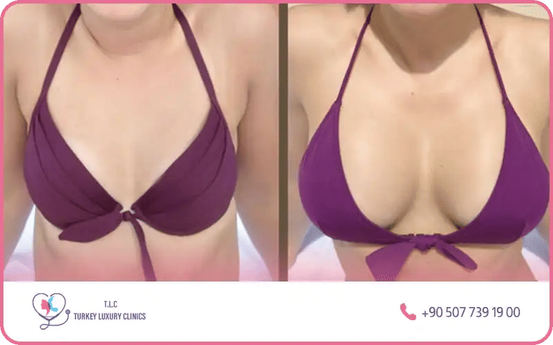 فوائد تكبير الثدي سيليكون 350