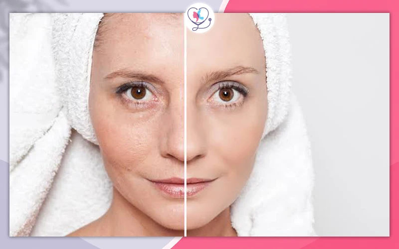 What Are the Benefits of Skin Boosters?