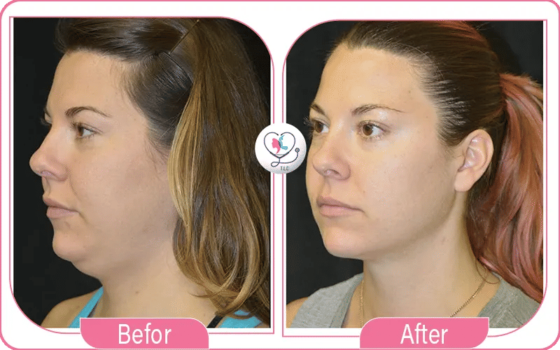 5. إنهاء الإجراء وتضميد المنطقة