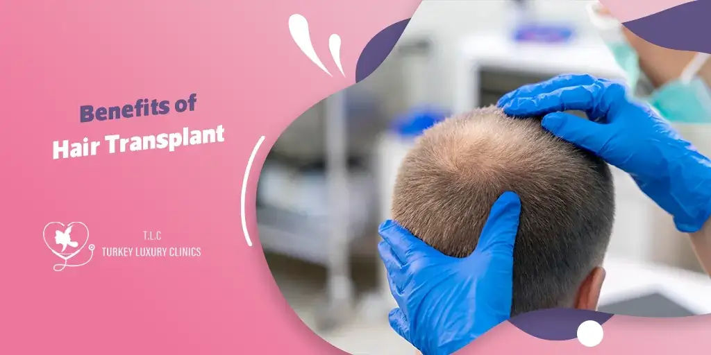 Benefits of Hair Transplant