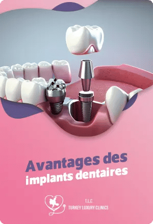 Avantages des implants dentaires