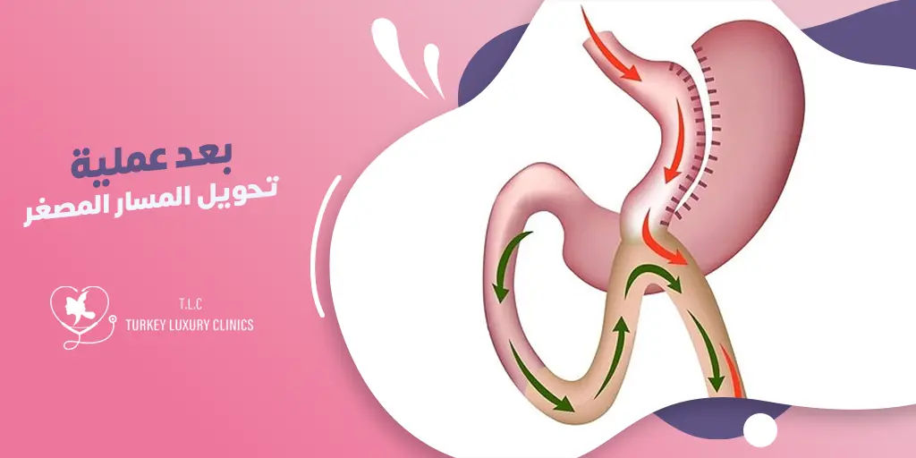 بعد عملية تحويل المسار المصغر