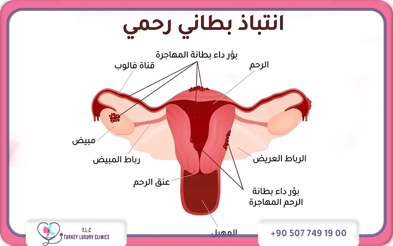 اعراض سرطان بطانة الرحم المهاجرة