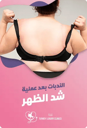 الندبات بعد عملية شد الظهر: كل ما يهمكfeatured image