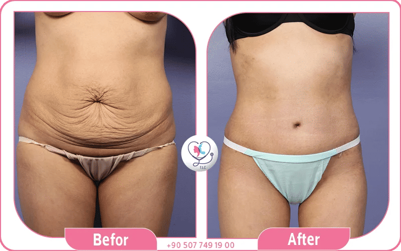 Mommy makeover tummy tuck shows tight, smooth abdomen with restored muscle tone.