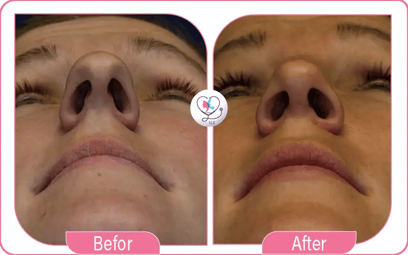 حالة أرنبة الأنف قبل العملية من حيث الوظيفة والتنفس