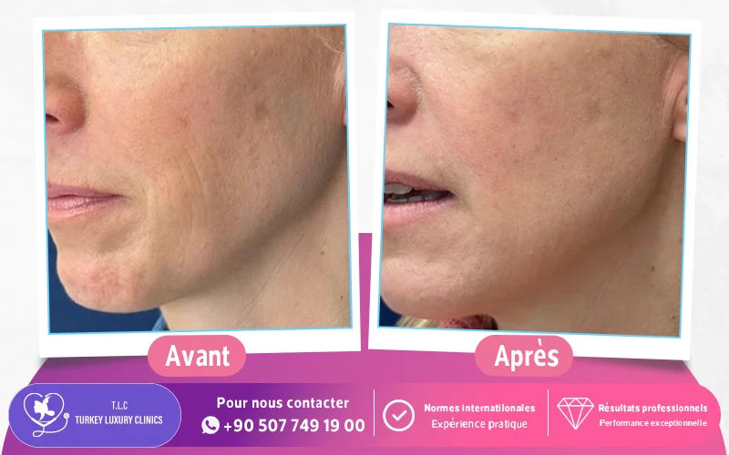 Photos résultats avant / après mésothérapie du visage
