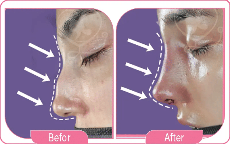 3. نفخ الأنف أو تنظيفه بعنف