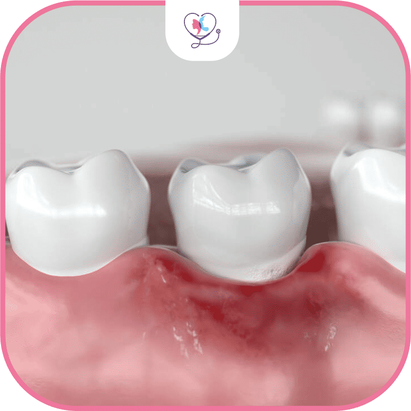 La parodontite - stades - causes et traitements