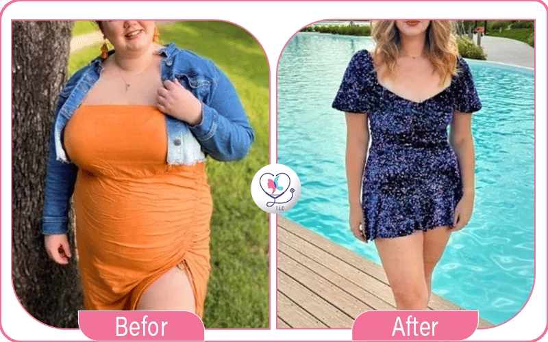 الحمل بعد التكميم: ما هي المخاطر؟-1772048967585