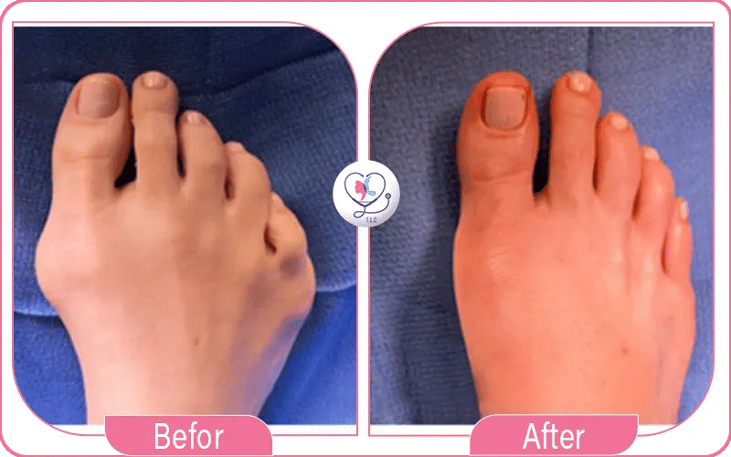 عملية تصغير القدم