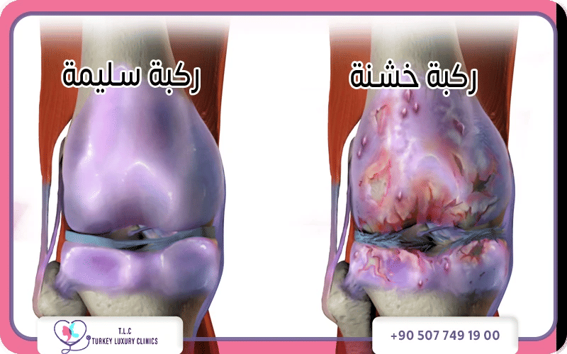 ما هو شكل خشونة الركبة بالصور؟ ما هو شكل خشونة الركبة بالصور؟