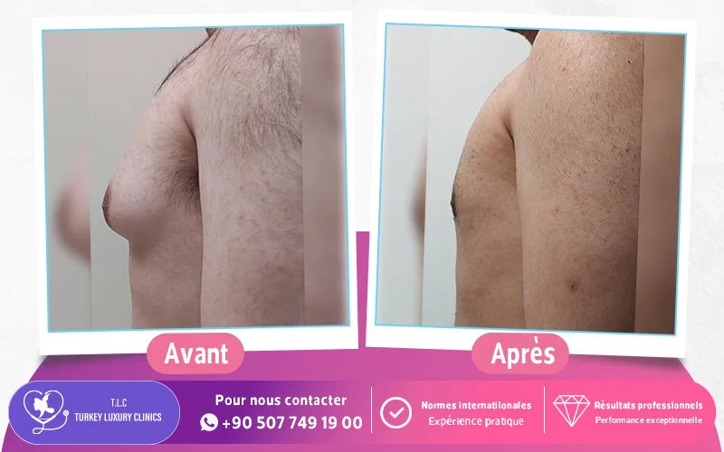 gynécomastie en Turquie avant apres