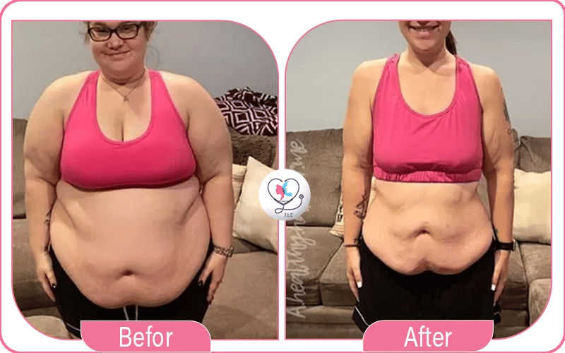 High BMI Lipo 360 Before and After Pictures