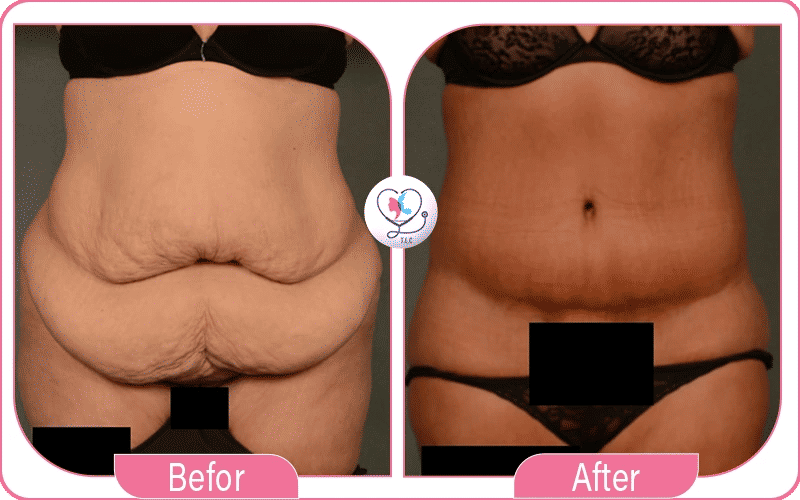 Full vs Mini Tummy Tuck Belly Button