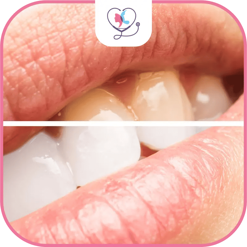 Décoloration dentaire