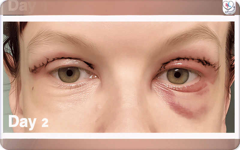 Blépharoplastie après 2 jours-2