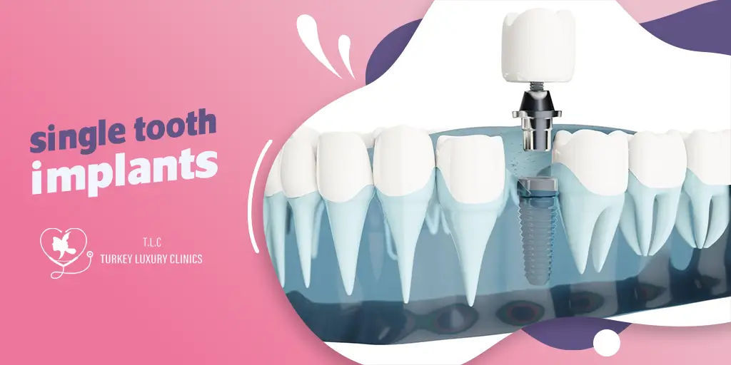 Implante dental de un diente: beneficios, costos y mejores opciones