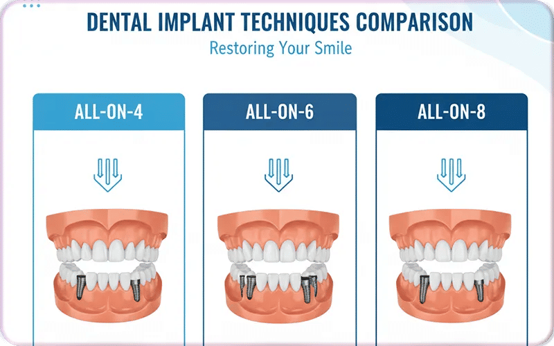 Options for Full Mouth Dental Implants in Turkey