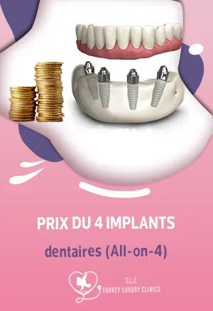 Prix du 4 implants dentaires (All-on-4)