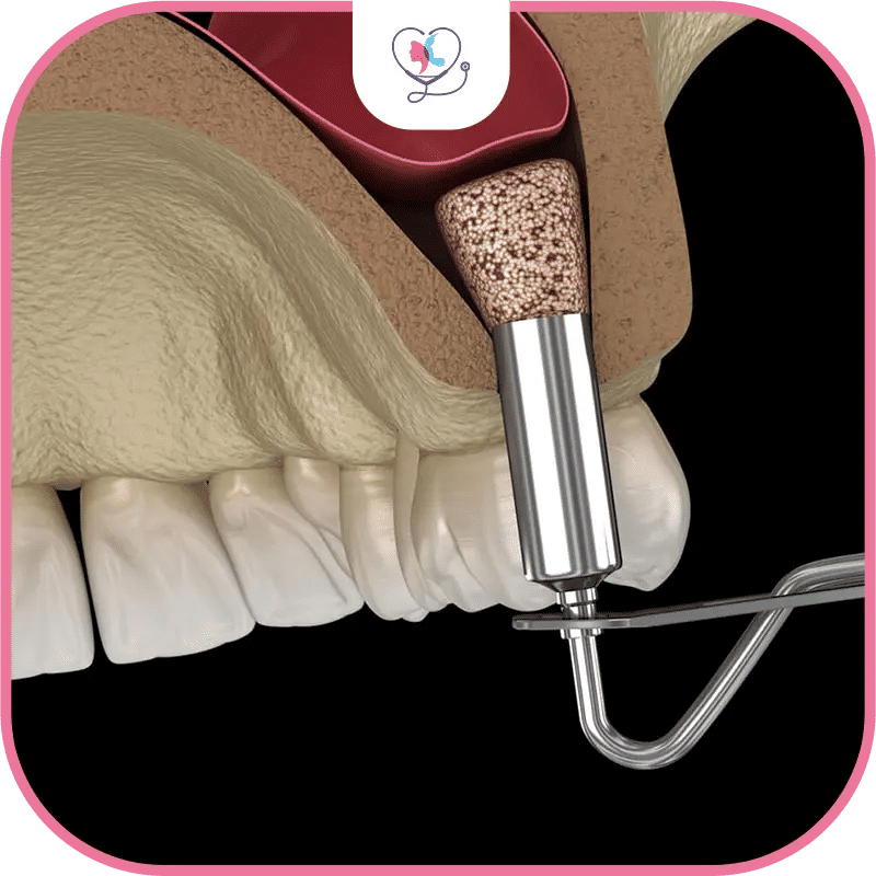 Who Is a Candidate for a Sinus Lift?