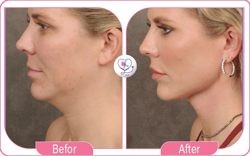 Neck Lift in Turkey Before and After Photos