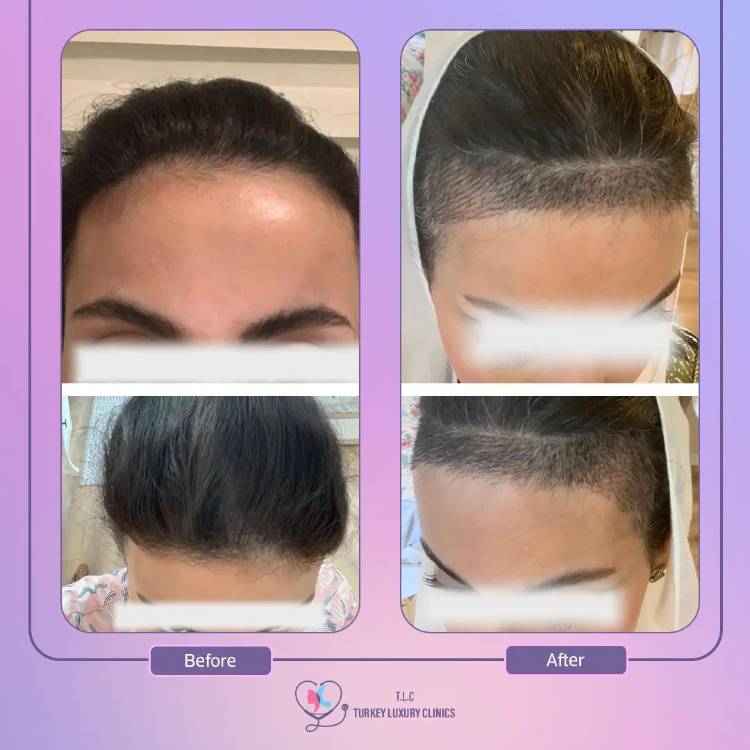 زراعة الشعر للنساء قبل وبعد